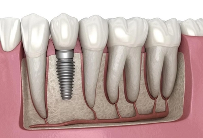 A model of a dental implant